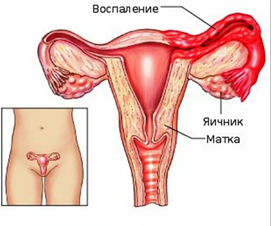 Картинка матка с придатками