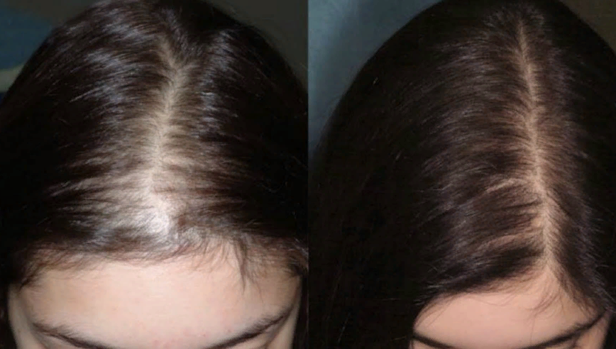 Дарсонваль против выпадения волос