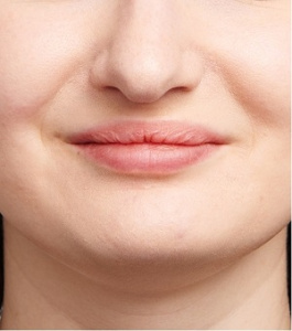 Коррекция формы и увеличение губ
 после процедуры