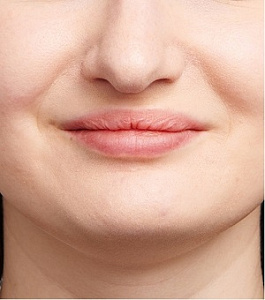Коррекция формы и увеличение губ
 после процедуры