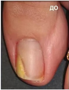 Лечение грибка ногтей до процедуры