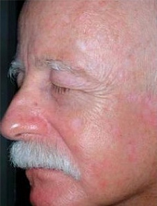 Лечение розацеа лазером на лице после процедуры
