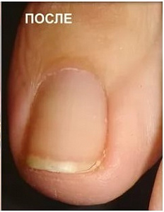 Лечение грибка ногтей после процедуры