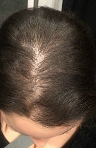 Лечение волос в Санкт-Петербурге до процедуры