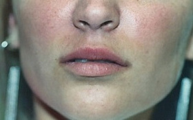Коррекция формы и увеличение губ
 после процедуры