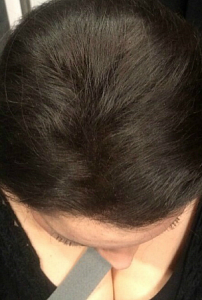 Лечение волос в Санкт-Петербурге после процедуры