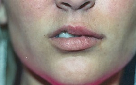 Коррекция формы и увеличение губ
 до процедуры